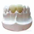 NP PFM, Most Common Type of Dental Crown
